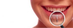 Avantajele implanturilor dentare